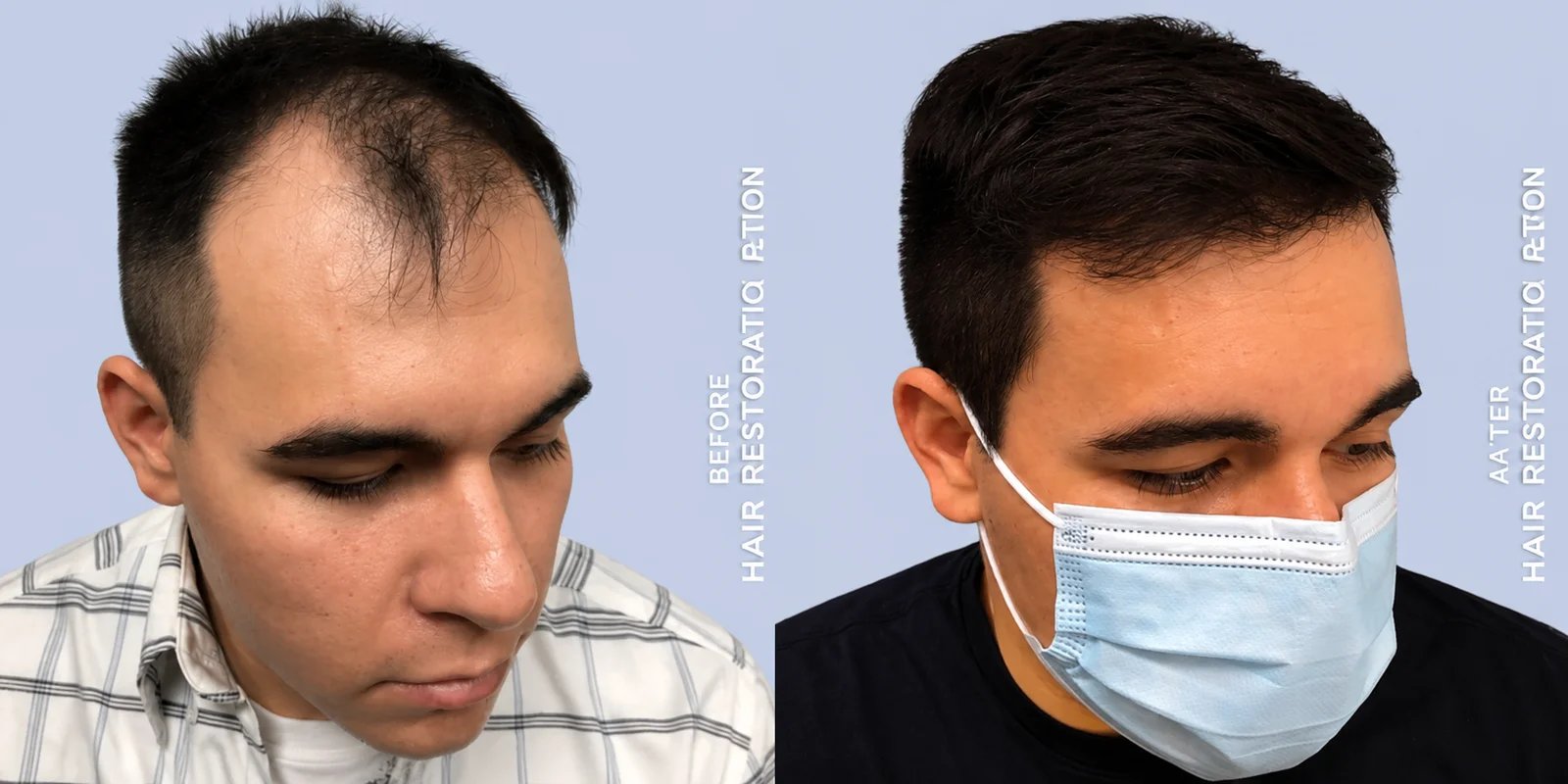 Men's hair transplant before and after — Doshi Plastic Surgery, Long Island