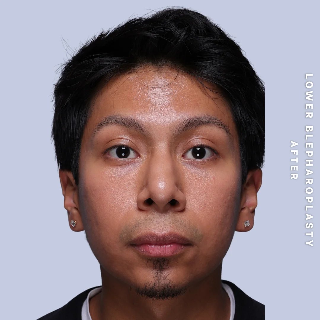 Men's Eyes Before & After Gallery - Patient 260630 - Image 2