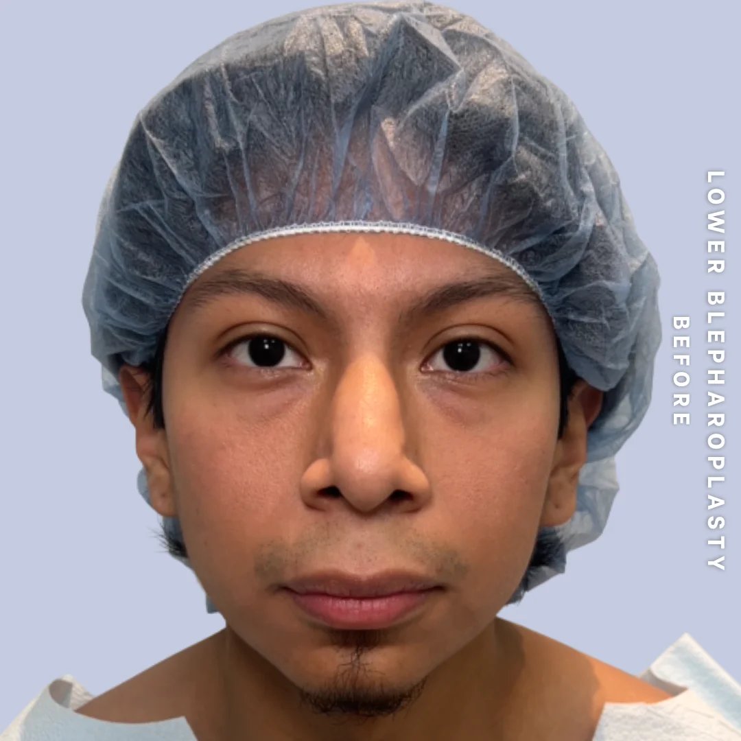 Men's Eyes Before & After Gallery - Patient 260630 - Image 1