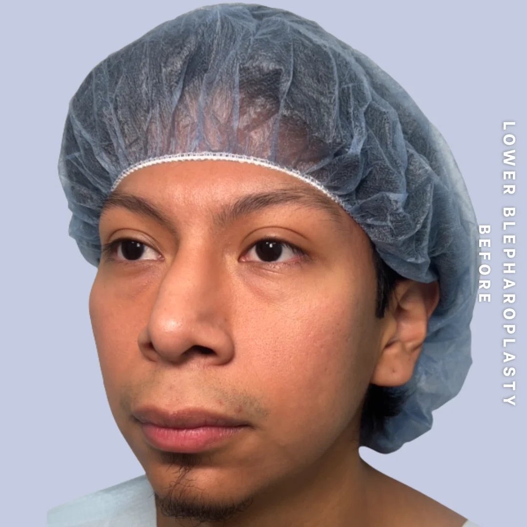 Men's Eyes Before & After Gallery - Patient 260630 - Image 3