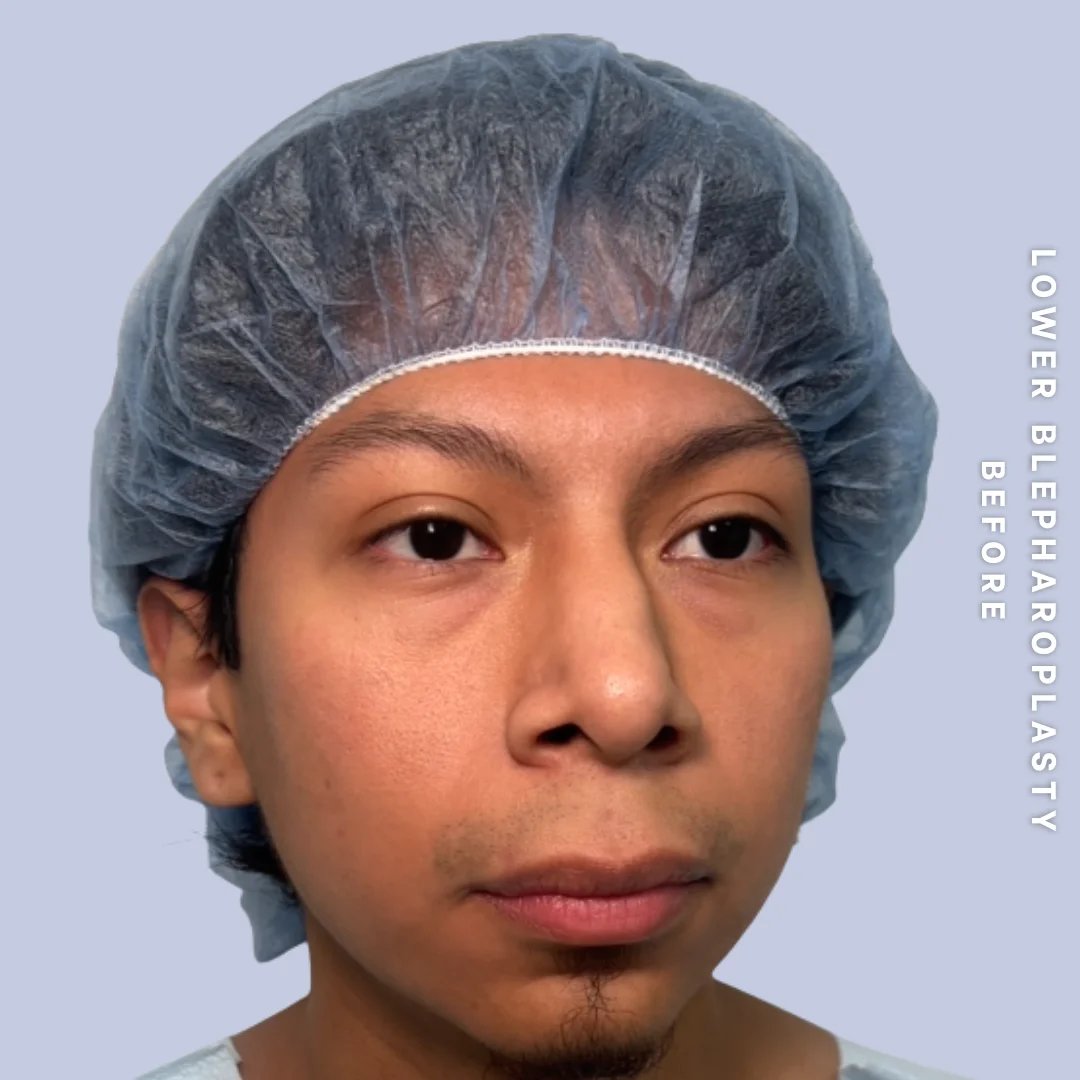 Men's Eyes Before & After Gallery - Patient 260630 - Image 5