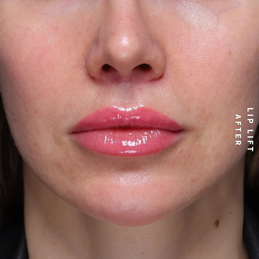 Lips Before & After Gallery - Patient 260624 - Image 2