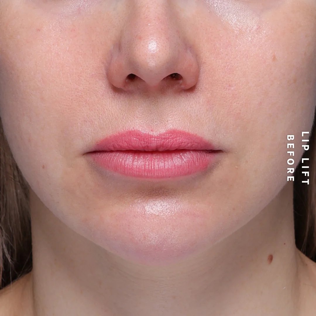 Lips Before & After Gallery - Patient 260624 - Image 1