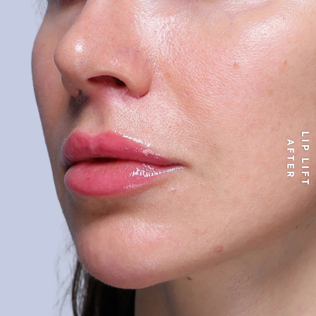Lips Before & After Gallery - Patient 260624 - Image 4