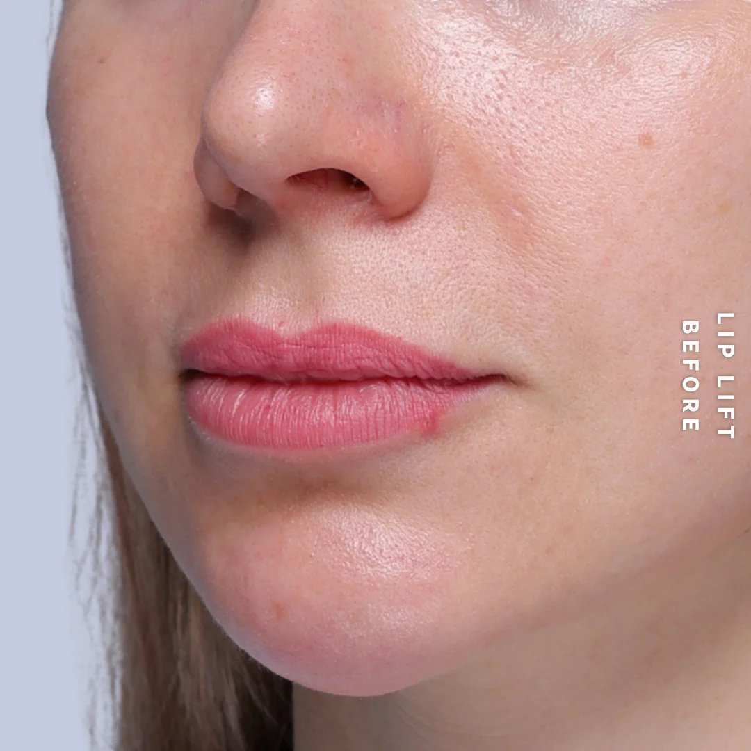 Lips Before & After Gallery - Patient 260624 - Image 3
