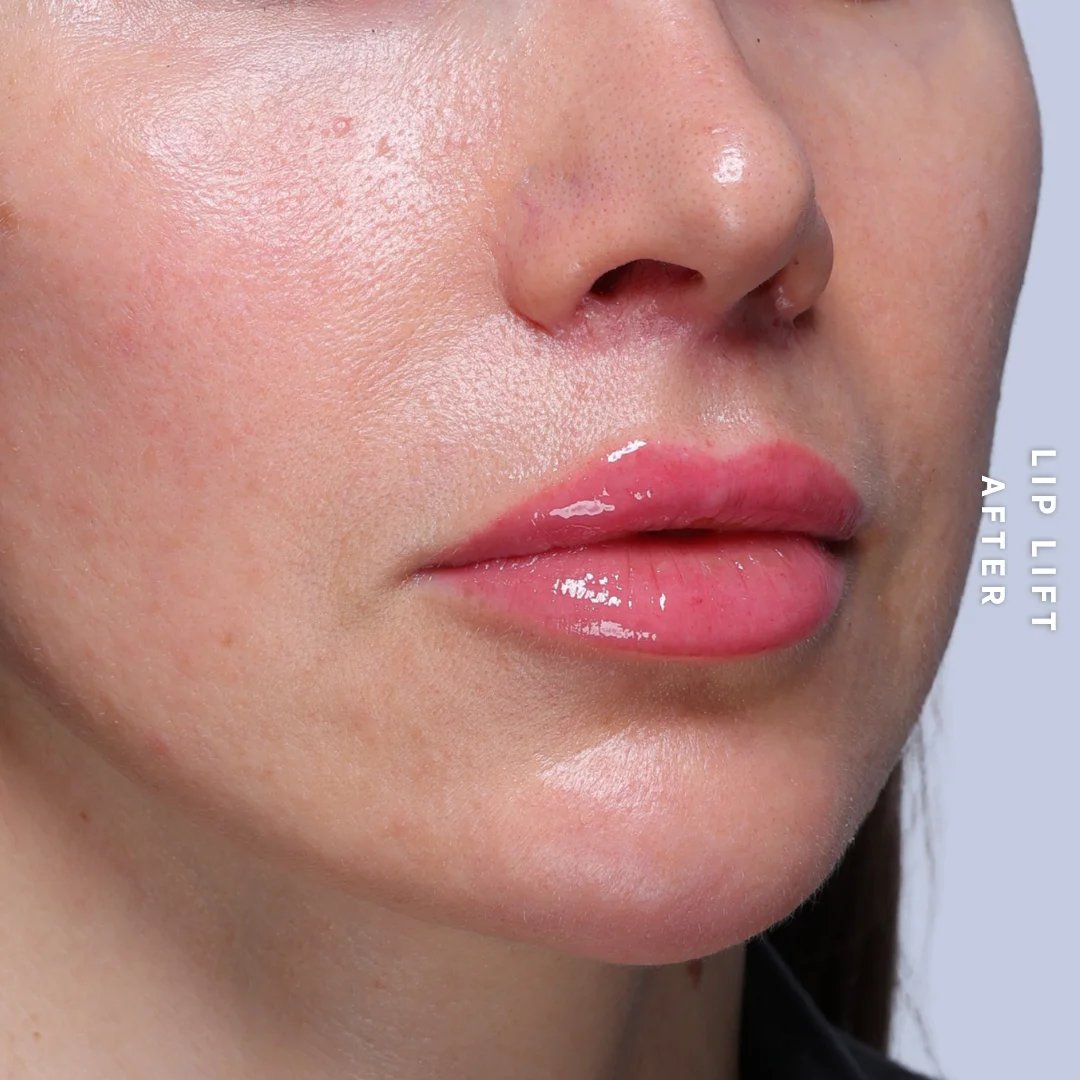 Lips Before & After Gallery - Patient 260624 - Image 6