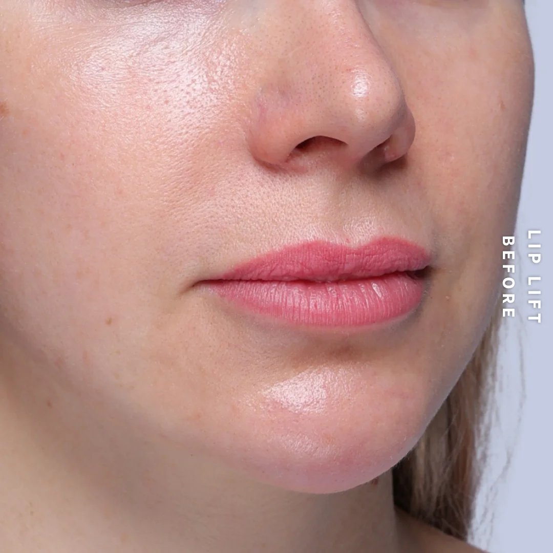 Lips Before & After Gallery - Patient 260624 - Image 5
