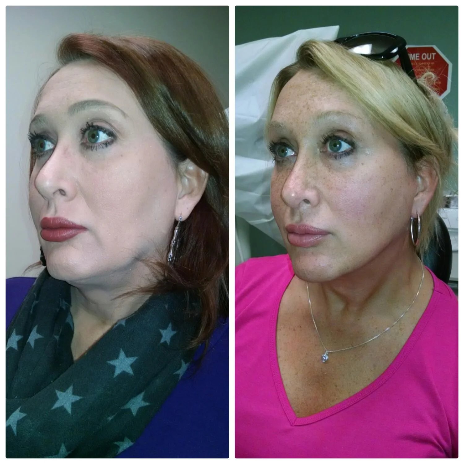 Neck lift before and after result — Doshi Plastic Surgery, Long Island