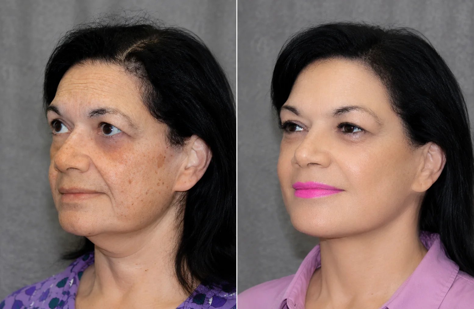 Neck lift before and after result showing a smoother jawline and neck contour — Doshi Plastic Surgery, Long Island