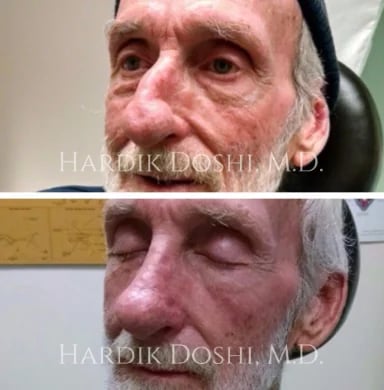 Before and after rhinoplasty by Dr. Hardik Doshi