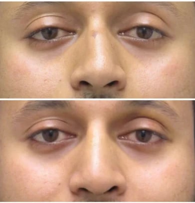 Rhinoplasty before and after by Dr. Hardik Doshi