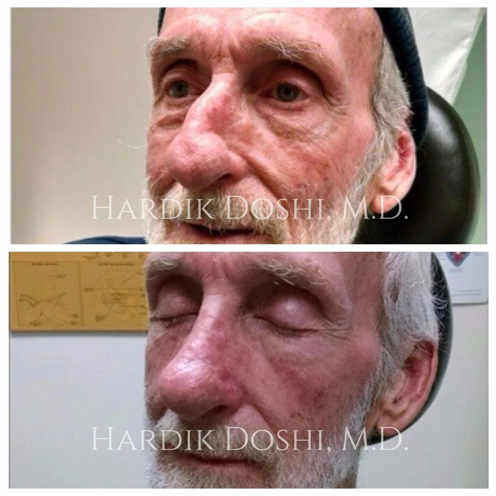 Rhinoplasty result — Doshi Plastic Surgery, Long Island