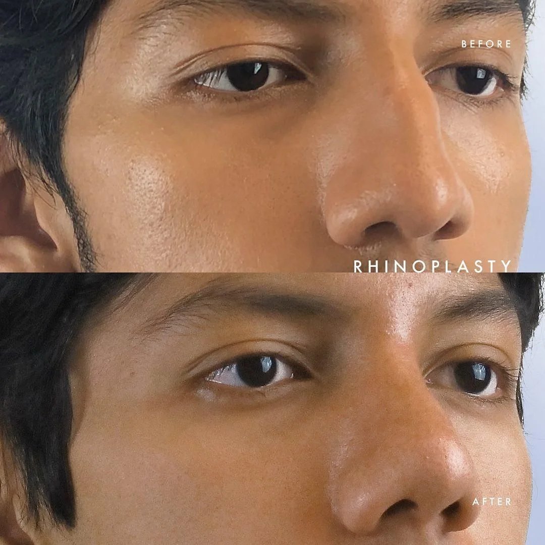 Preservation Rhinoplasty vs Traditional Rhinoplasty