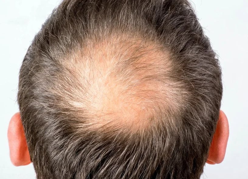 Top-down view of a man's crown showing thinning hair and visible scalp