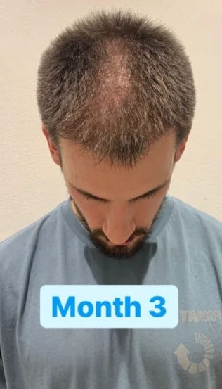 Scalp at month three after FUE, during the shock loss shedding phase