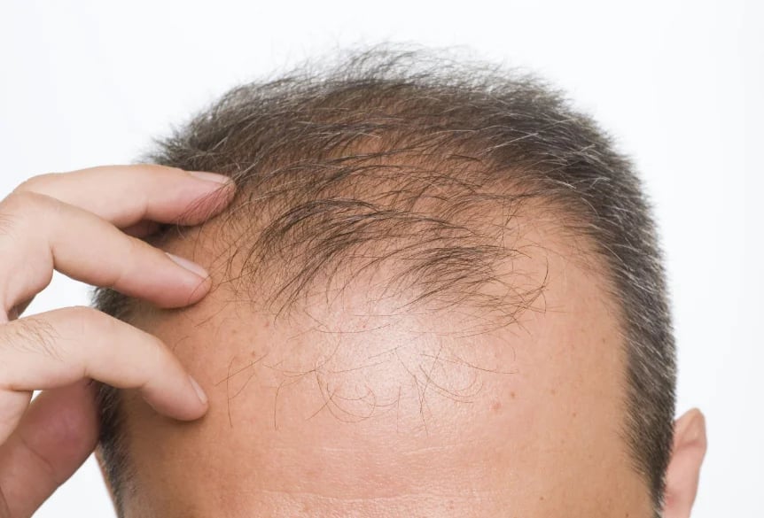Dr. Hardik Doshi  Blog | Hair Transplant Shock Loss: Why Your Existing Hair Falls Out After FUE (and When It Grows Back)