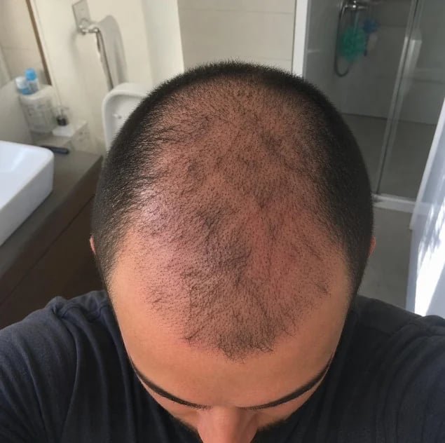 Dr. Hardik Doshi  Blog | Hair Transplant Shock Loss: Why Your Existing Hair Falls Out After FUE (and When It Grows Back)