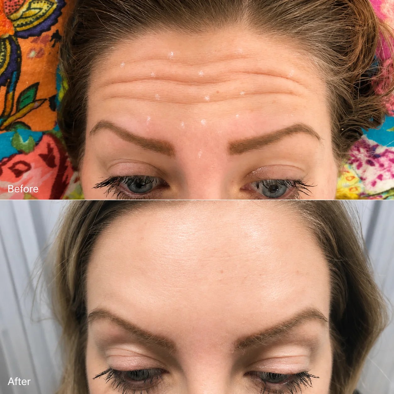 Botox forehead before and after — horizontal forehead lines smoothed after treatment — Doshi Plastic Surgery, Long Island