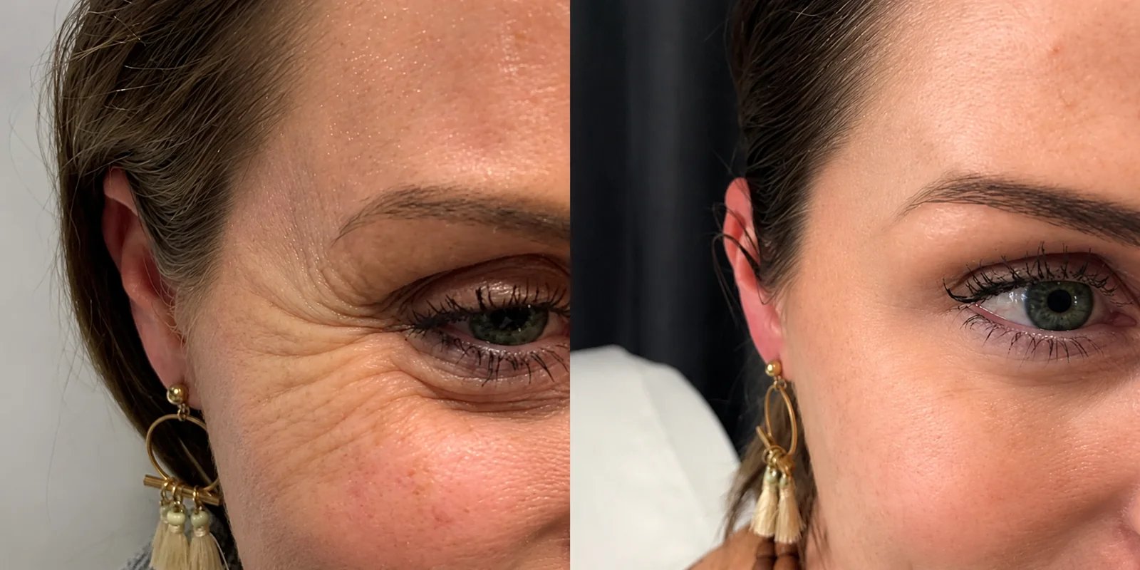 Botox crow's feet before and after — outer-eye wrinkles softened after treatment — Doshi Plastic Surgery, Long Island