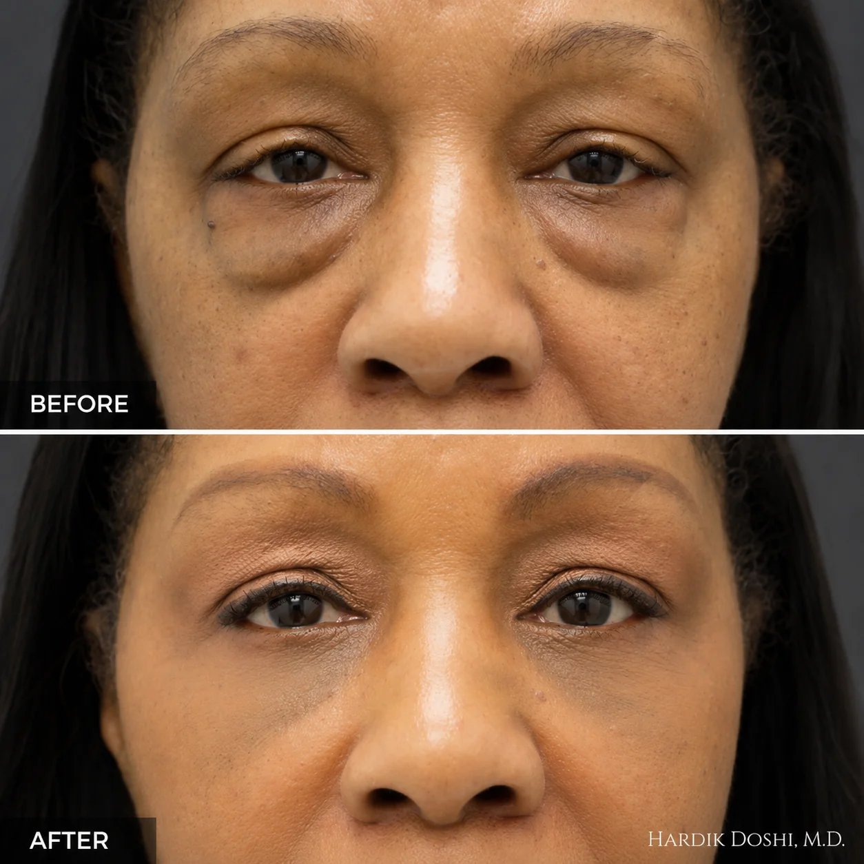 Blepharoplasty before and after — female patient of Dr. Hardik Doshi
